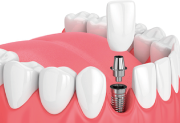 evolution-dental-dental-implants
