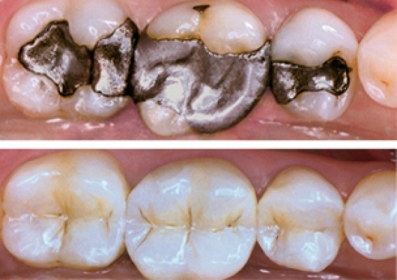 Evolution Dental Fillings